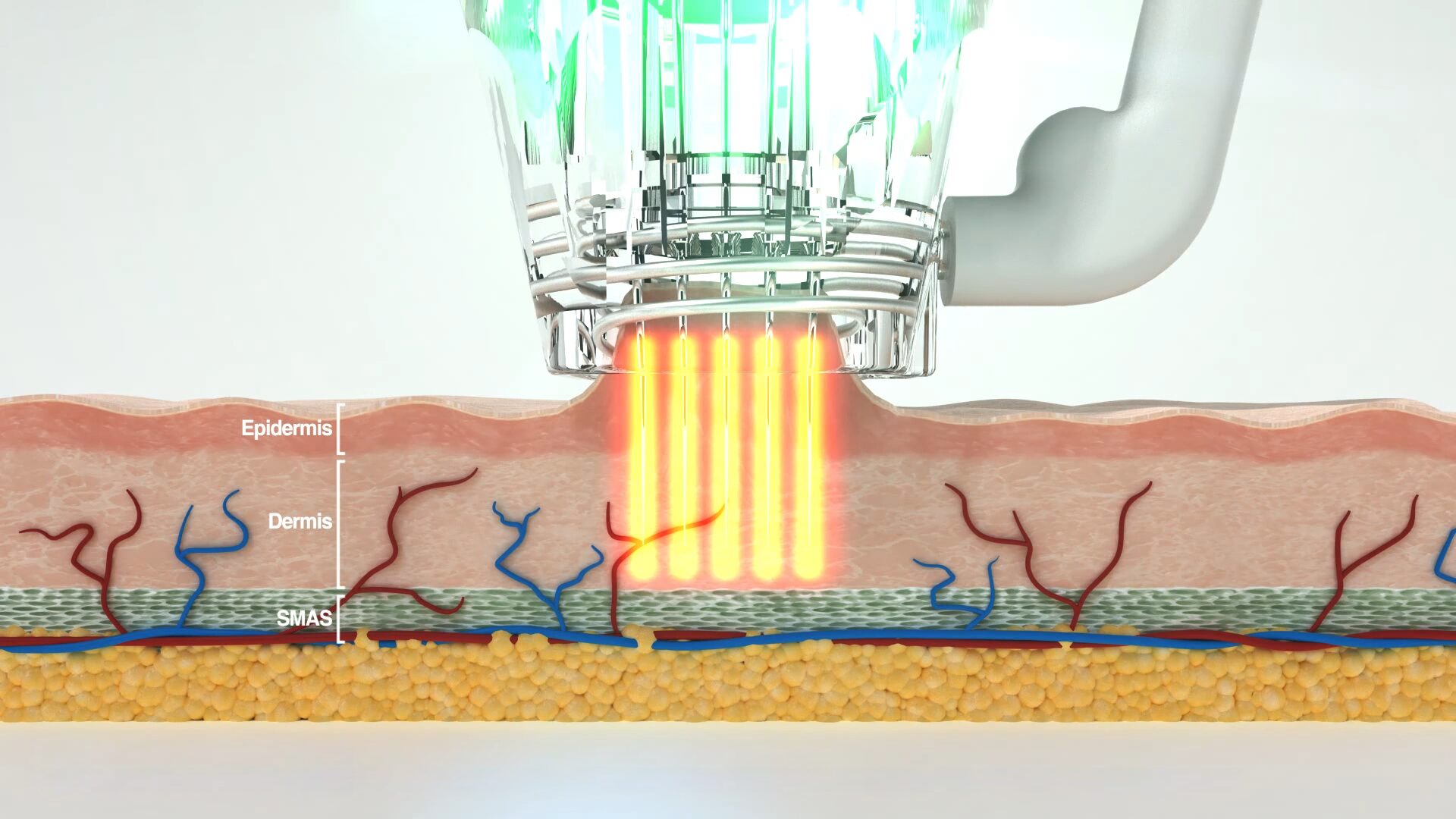 Radiofrequency Microneedling On Skin