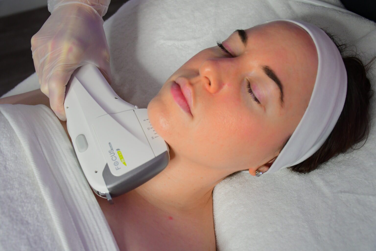 Focus Dual HIFU Treatment on Ladies Chin HIFU