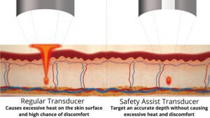 Safe HIFU treatments using FOCUS DUAL SAT Technology