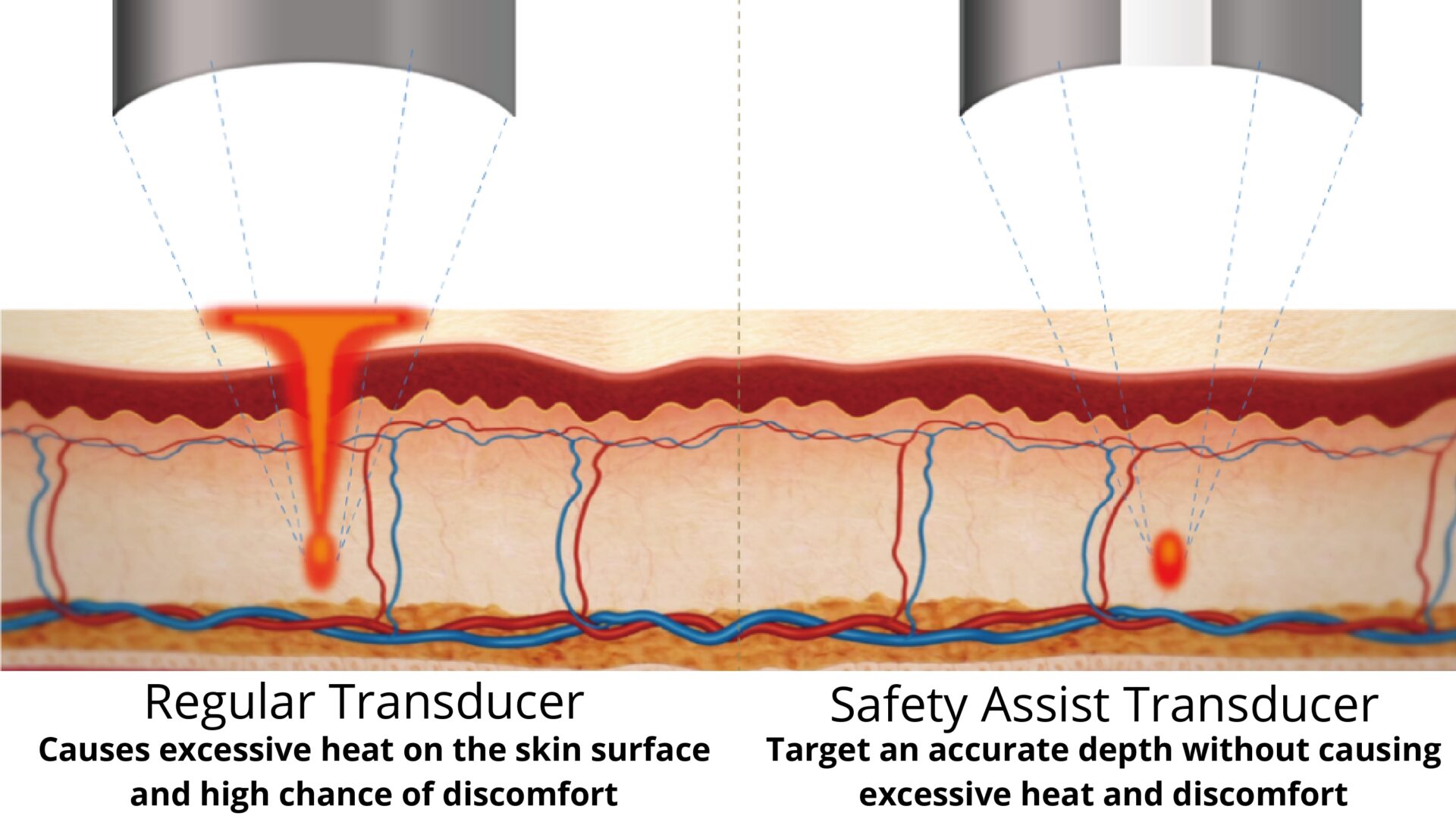 Safe HIFU treatments using FOCUS DUAL SAT Technology