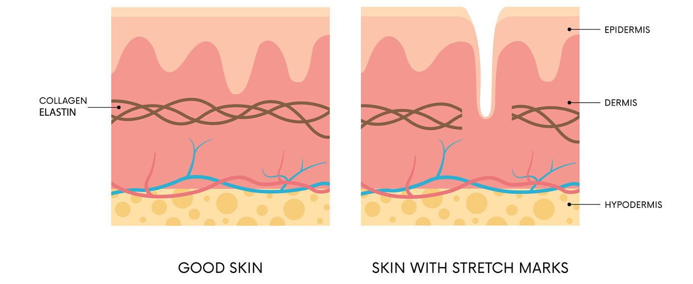 How Stretch Marks are Formed