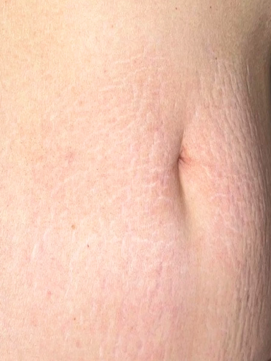 Stretch Marks After 3 RF Microneedle