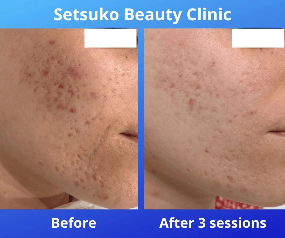 Acne Scars before and after RF Microneedling