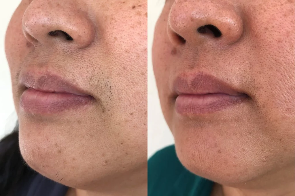 Reduced hair after Laser hair removal on face