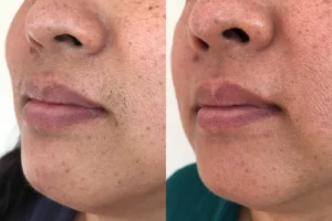 Reduced hair after Laser hair removal on face