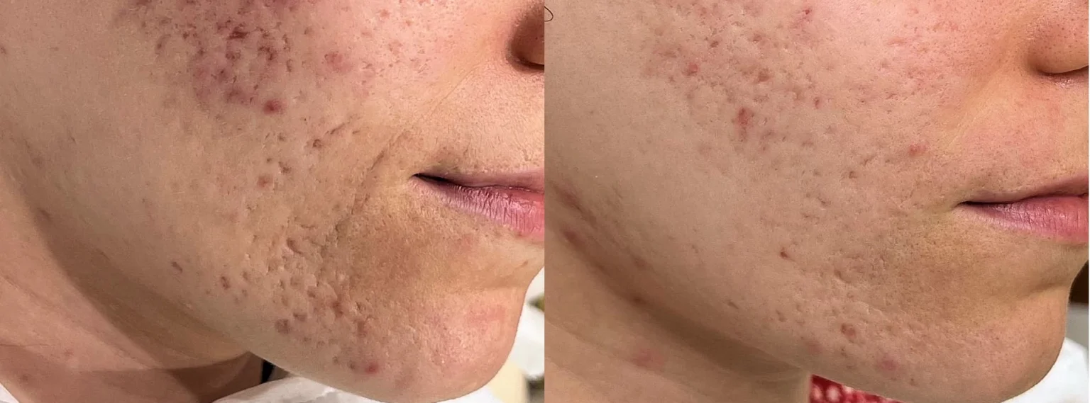 Before and after RF Microneedling for Acne Scars