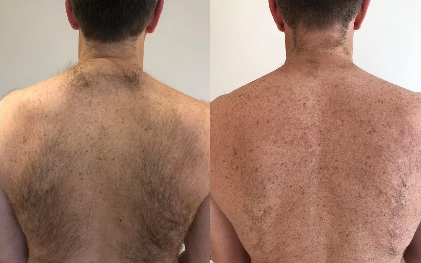 Reduced hair after laser hair removal on back