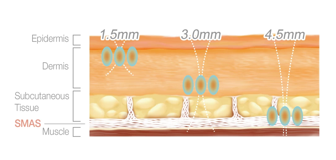 Skin Layers treated by HIFU facial using FOCUS Dual