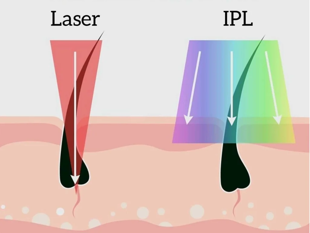 The difference between Laser and IPL hair removal