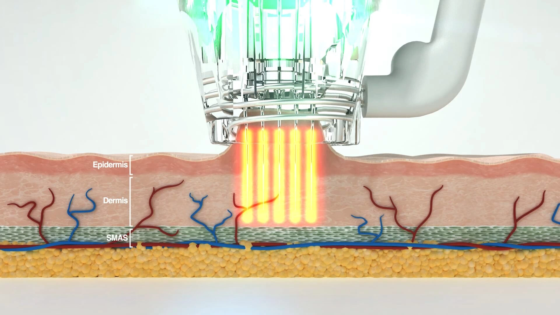 Radiofrequency Microneedling On Skin with FOCUS Dual