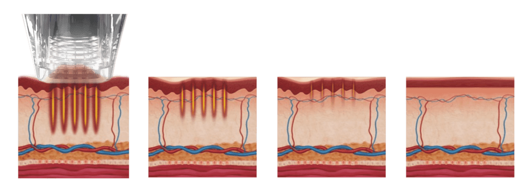 RF Microneedling effect over time