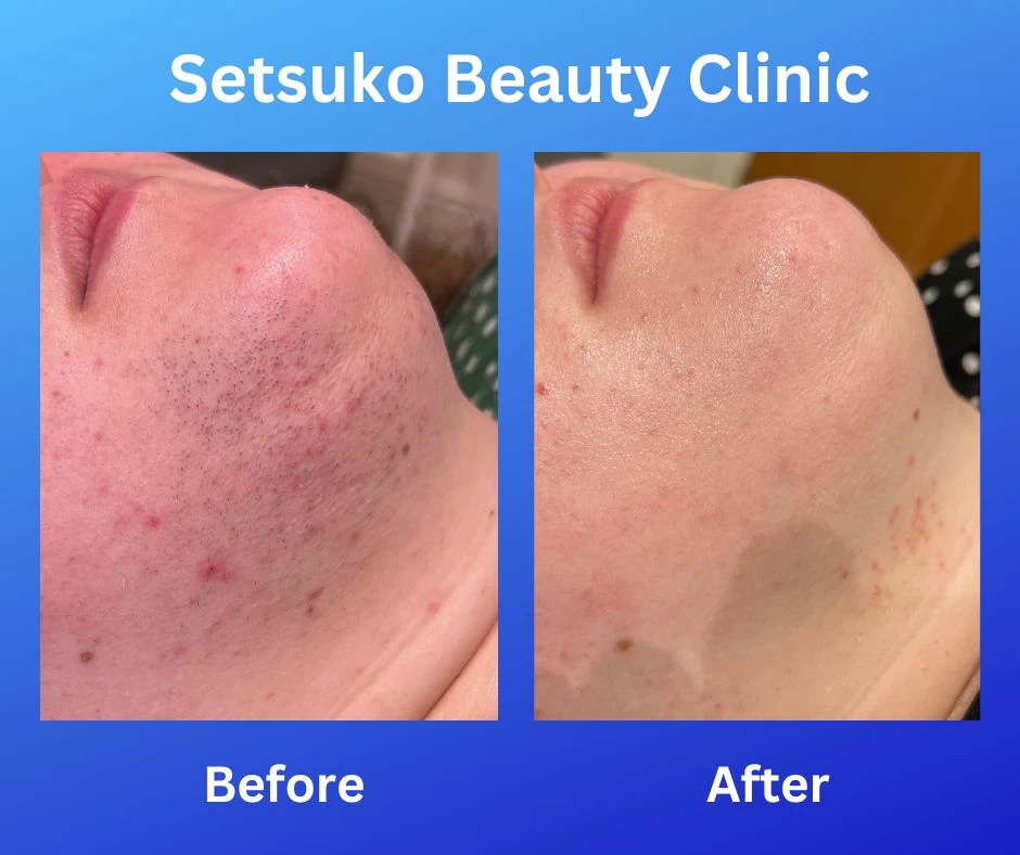 Chin Before and After Laser Hair Removal at Setsuko Beauty Clinic