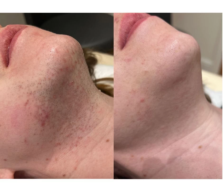 Setsuko Beauty Clinic Before and after Laser hair Removal on Chin