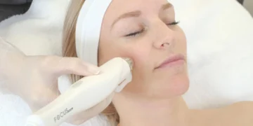 Does microneedling with RF really work?
