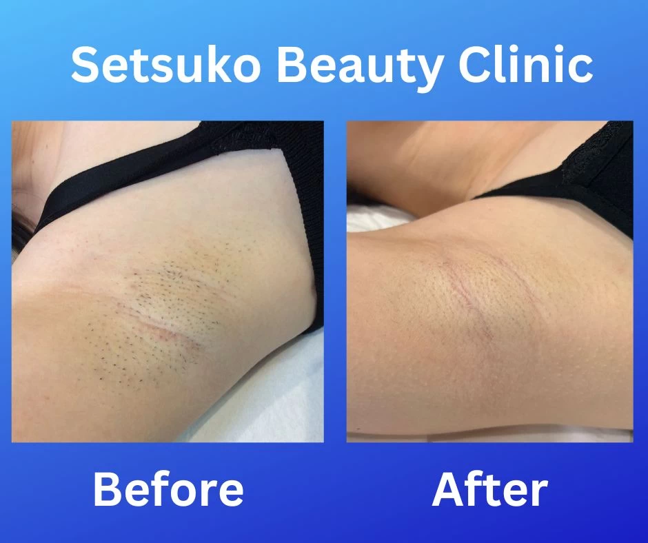 Before after laser hair removal 3