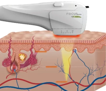 Focus Dual HIFU and Skin Layers