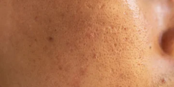 Acne scars