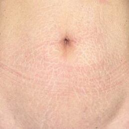 Stretch Marks Before RF Microneedling
